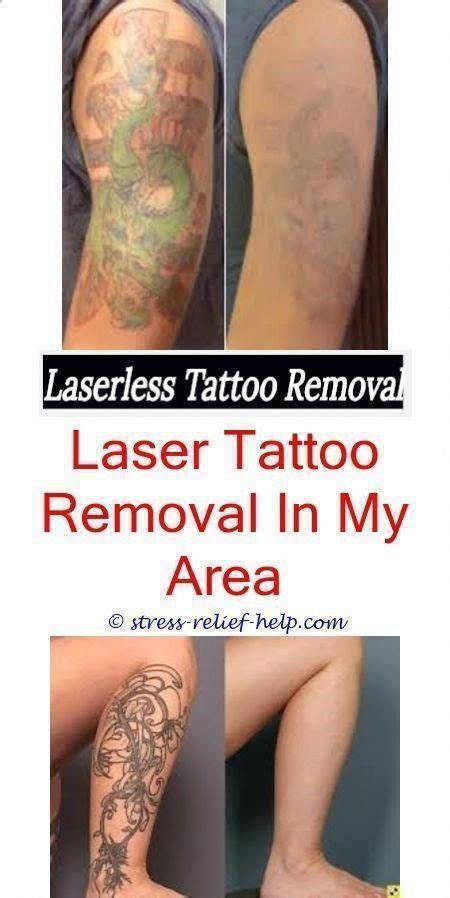 tattoo removal philippines